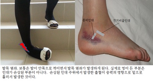 발목 멍·인대 손상 — 부상 직후 단계