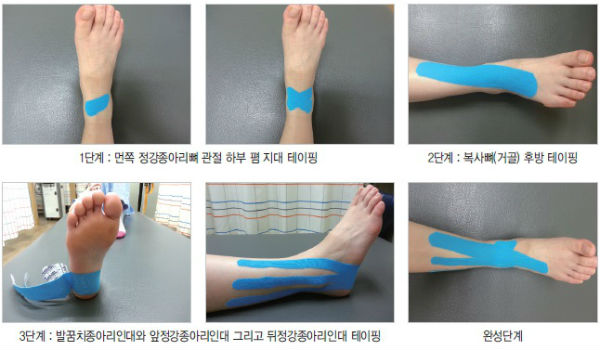 발목 테이핑 단계별 가이드 — 스터럽·피겨에잇