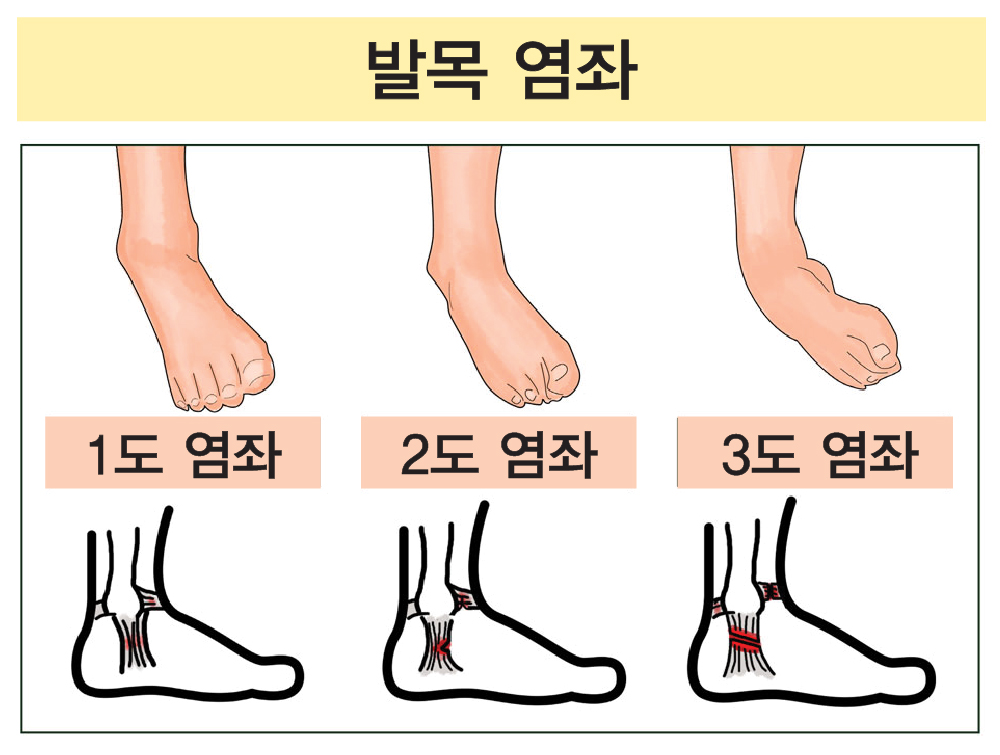 발목염좌 1·2·3도 단계별 비교