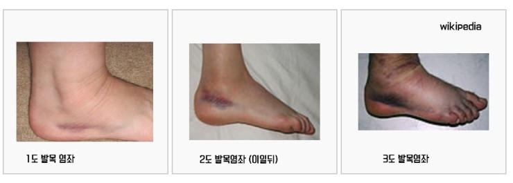 발목염좌 1·2·3도 비교