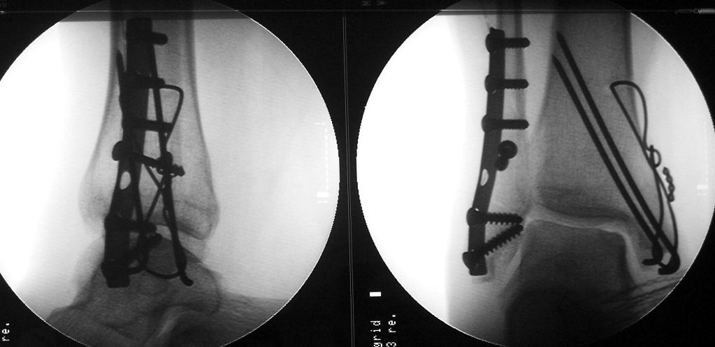 수술 후 금속 고정 X-ray (참고)