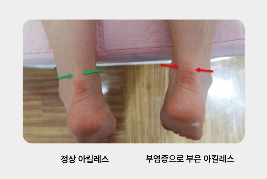 정상 아킬레스건 vs 염증 아킬레스건 비교