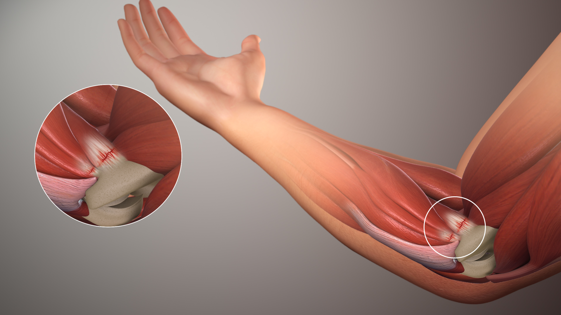 팔꿈치 안쪽 힘줄 부착부의 미세 손상을 확대해 보여주는 3D 의학 일러스트 — 골프엘보가 생기는 지점