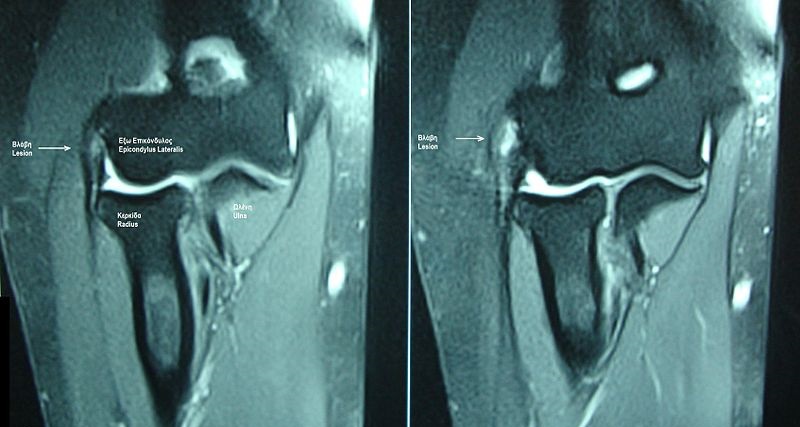 외측상과염 MRI 영상